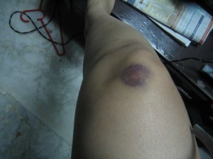 Only I could learn how to fall UP the stairs